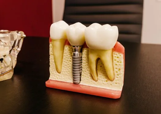 Implante dental paso a paso: cuánto tarda cada etapa
