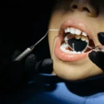 La caries no duele hasta que es tarde: cómo adelantarse