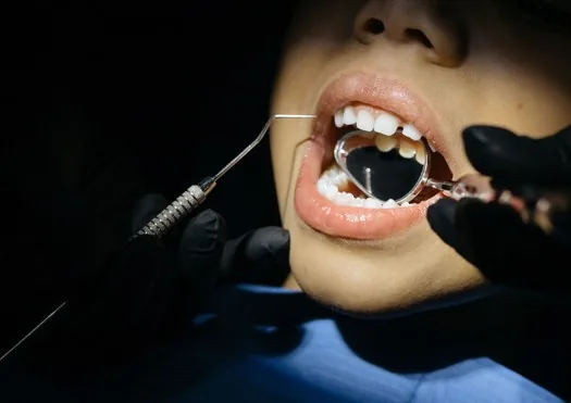 La caries no duele hasta que es tarde: cómo adelantarse